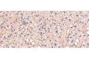 Immunohistochemistry of paraffin-embedded Human liver cancer tissue using RIOK1 Polyclonal Antibody at dilution of 1:80(x200)