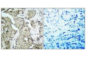 Immunohistochemical analysis of paraffin- embedded human breast carcinoma tissue using MKK6(Phospho-Ser207) Antibody(left) or the same antibody preincubated with blocking peptide(right). (MAP2K6 antibody  (pSer207))