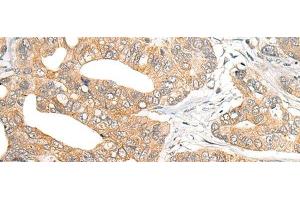 Immunohistochemistry of paraffin-embedded Human gastric cancer tissue using SNX6 Polyclonal Antibody at dilution of 1:40(x200)