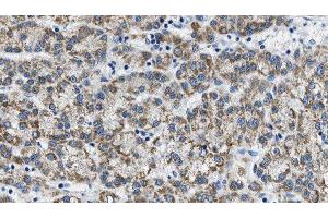 ABIN6275828 at 1/100 staining Human liver cancer tissue by IHC-P. (PIK3 gamma antibody  (C-Term))