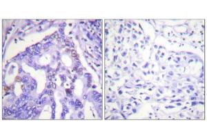 Immunohistochemistry analysis of paraffin-embedded human lung carcinoma tissue using PIAS4 antibody. (PIAS4 antibody  (C-Term))