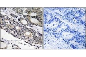 Immunohistochemistry analysis of paraffin-embedded human colon carcinoma tissue, using BCL10 Antibody. (BCL10 antibody  (AA 111-160))