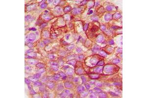 Immunohistochemical analysis of c-SRC staining in human breast cancer formalin fixed paraffin embedded tissue section. (Src antibody  (C-Term))