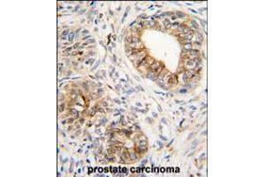 Formalin-fixed and paraffin-embedded human prostata carcinoma tissue reacted with PTGS1 antibody , which was peroxidase-conjugated to the secondary antibody, followed by DAB staining. (PTGS1 antibody  (C-Term))
