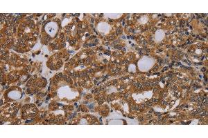 Immunohistochemistry of paraffin-embedded Human thyroid cancer tissue using PARP8 Polyclonal Antibody at dilution 1:40 (PARP8 antibody)