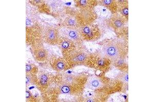 Immunohistochemical analysis of SHMT2 staining in human liver cancer formalin fixed paraffin embedded tissue section. (SHMT2 antibody)