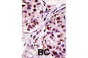 Formalin-fixed and paraffin-embedded human cancer tissue reacted with the primary antibody, which was peroxidase-conjugated to the secondary antibody, followed by AEC staining. (HGS antibody  (N-Term))