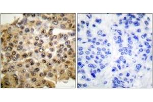 Immunohistochemistry analysis of paraffin-embedded human breast carcinoma tissue, using p44/42 MAPK Antibody. (ERK1/2 antibody  (AA 330-379))