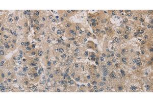 Immunohistochemistry of paraffin-embedded Human liver cancer using ESRRG Polyclonal Antibody at dilution of 1:30 (ESRRG antibody)