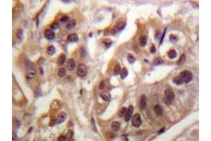 Immunohistochemistry analyzes of IKKγ antibody in paraffin-embedded human breast carcinoma tissue. (IKBKG antibody)