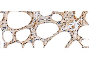 Immunohistochemistry of paraffin-embedded Human thyroid cancer tissue using RAB11A Polyclonal Antibody at dilution of 1:35(x200) (RAB11A antibody)