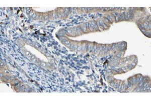 ABIN6277956 at 1/100 staining Human cervical cancer tissue by IHC-P.
