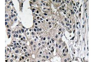 Immunohistochemistry analyzes of Caspase-7 antibody in paraffin-embedded human breast carcinoma tissue. (Caspase 7 antibody)
