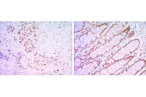 Immunohistochemical analysis of paraffin-embedded lung cancer tissues (left) and human rectum tissues (right) using KLF4 antibody with DAB staining. (KLF4 antibody)
