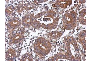 IHC-P Image Immunohistochemical analysis of paraffin-embedded human colon carcinoma, using PPM1J, antibody at 1:500 dilution.