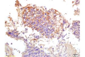 Formalin-fixed and paraffin embedded human lung carcinoma labeled with Anti-Phospho-ATP1A1(Tyr10) Polyclonal Antibody, Unconjugated (ABIN683173) at 1:200 followed by conjugation to the secondary antibody and DAB staining.