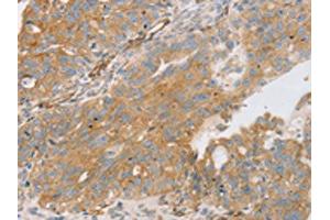 The image on the left is immunohistochemistry of paraffin-embedded Human breast cancer tissue using ABIN7131237(STX16 Antibody) at dilution 1/30, on the right is treated with fusion protein. (Syntaxin 16 antibody)
