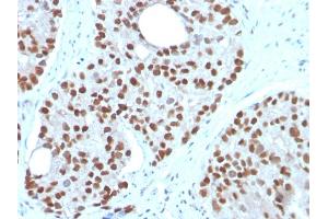Formalin-fixed, paraffin-embedded human Prostate Carcinoma stained with NKX3.