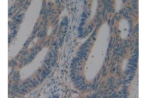 DAB staining on IHC-P; Samples: Human Colorectal cancer Tissue (LAP antibody  (AA 320-519))