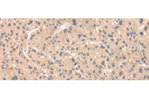 Immunohistochemistry of paraffin-embedded Human liver cancer tissue using ZNF268 Polyclonal Antibody at dilution of 1:50(x200)