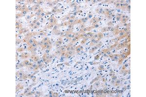 Immunohistochemistry of Human thyroid cancer using FGF4 Polyclonal Antibody at dilution of 1:40