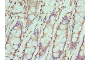 Immunohistochemistry of paraffin-embedded human colon cancer using ABIN7156622 at dilution of 1:100