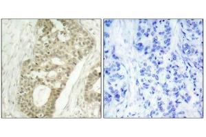 Immunohistochemical analysis of paraffin-embedded human breast carcinoma tissue using PKCd(Phospho-Ser645) Antibody(left) or the same antibody preincubated with blocking peptide(right). (PKC delta antibody  (pSer645))
