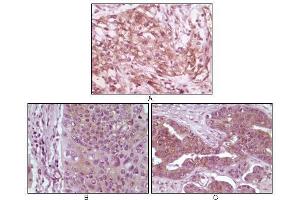 Immunohistochemical analysis of paraffin-embedded human pancreas carcinoma (A), esophagus carcinoma tissue (B) and ovary tumor tissue, showing cytoplasmic and membrane localization using 4E-BP1 mouse mAb with DAB staining. (eIF4EBP1 antibody)