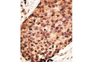 Formalin-fixed and paraffin-embedded human cancer tissue reacted with the primary antibody, which was peroxidase-conjugated to the secondary antibody, followed by AEC staining. (MMP16 antibody  (N-Term))