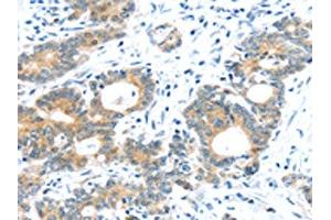 The image on the left is immunohistochemistry of paraffin-embedded Human colorectal cancer tissue using ABIN7192957(TUSC1 Antibody) at dilution 1/30, on the right is treated with synthetic peptide. (TUSC1 antibody)