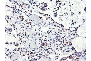 Immunohistochemical staining of paraffin-embedded Adenocarcinoma of Human colon tissue using anti-NLN mouse monoclonal antibody.