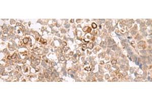 Immunohistochemistry of paraffin-embedded Human ovarian cancer tissue using MCAM Polyclonal Antibody at dilution of 1:40(x200) (MCAM antibody)