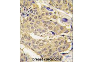 Formalin-fixed and paraffin-embedded human breast carcinoma tissue reacted with EPRS antibody , which was peroxidase-conjugated to the secondary antibody, followed by DAB staining. (EPRS antibody  (N-Term))