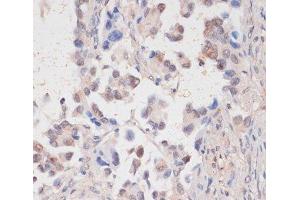 Immunohistochemistry of paraffin-embedded Human lung cancer using HTATSF1 Polyclonal Antibody at dilution of 1:100 (40x lens). (HTATSF1 antibody)
