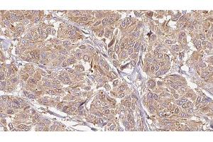 ABIN6276604 at 1/100 staining Human Melanoma tissue by IHC-P. (LCN6 antibody  (Internal Region))