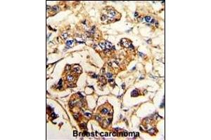 Formalin-fixed and paraffin-embedded human breast carcinoma reacted with ACTN4 Antibody (C-term), which was peroxidase-conjugated to the secondary antibody, followed by DAB staining. (alpha Actinin 4 antibody  (C-Term))