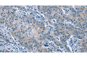 Immunohistochemistry of paraffin-embedded Human gastric cancer tissue using GAS2 Polyclonal Antibody at dilution 1:50 (GAS2 antibody)