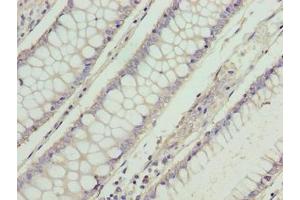 Immunohistochemistry of paraffin-embedded human colon cancer using ABIN7166002 at dilution of 1:100