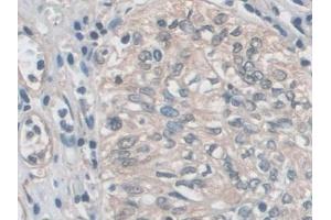 Detection of EZR in Human Prostate cancer Tissue using Polyclonal Antibody to Ezrin (EZR) (Ezrin antibody  (AA 1-295))