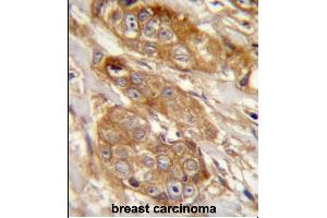 GRINA Antibody (Center) (ABIN657481 and ABIN2846508) immunohistochemistry analysis in formalin fixed and paraffin embedded human breast carcinoma followed by peroxidase conjugation of the secondary antibody and DAB staining. (GRINA antibody  (AA 131-158))