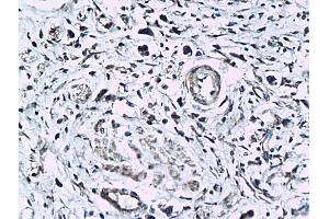 Formalin-fixed and paraffin embedded human colorectal cancer labeled with Anti-phospho-KLF5(Ser275) Polyclonal Antibody, Unconjugated (ABIN676778) followed by conjugation to the secondary antibody and DAB staining (KLF5 antibody  (pSer275))