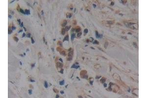 Detection of MAPT in Human Breast cancer Tissue using Polyclonal Antibody to Tau Protein (MAPT)