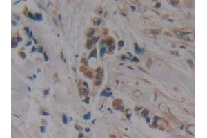 Detection of MAPT in Human Breast cancer Tissue using Polyclonal Antibody to Tau Protein (MAPT) (tau antibody  (AA 130-386))