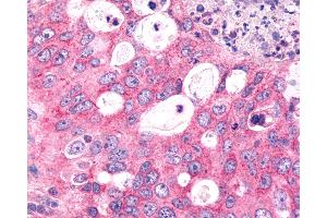 Anti-FZD6 / Frizzled 6 antibody IHC of human Lung, Non-Small Cell Carcinoma.