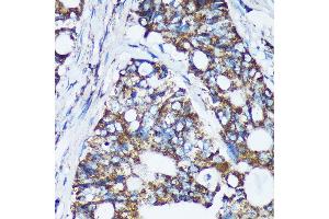 Immunohistochemistry of paraffin-embedded Human colon carcinoma using CDKL3 Rabbit pAb (ABIN7266612) at dilution of 1:100 (40x lens). (CDKL3 antibody  (AA 1-120))