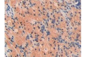 Detection of OIT3 in Human Lung cancer Tissue using Polyclonal Antibody to Oncoprotein Induced Transcript 3 (OIT3) (OIT3 antibody  (AA 297-506))
