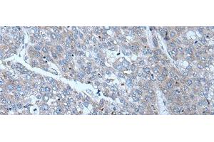 Immunohistochemistry of paraffin-embedded Human liver cancer tissue using SLC24A5 Polyclonal Antibody at dilution of 1:50(x200) (SLC24A5 antibody)