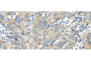 Immunohistochemistry of paraffin-embedded Human breast cancer using TXNDC5 Polyclonal Antibody at dilution of 1/40 (TXNDC5 antibody)