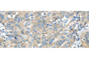 Immunohistochemistry of paraffin-embedded Human breast cancer using TXNDC5 Polyclonal Antibody at dilution of 1/40