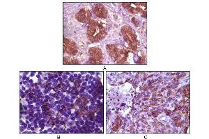 Immunohistochemical analysis of paraffin-embedded human breast tissue (A), lymph tissue (B) and skin carcinoma (C), showing membrane localization using BLK mouse mAb with DAB staining. (BLK antibody)